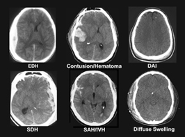 brain scans of tbi patients