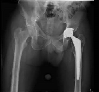 xray osteolysis Connexion GXL liner hip